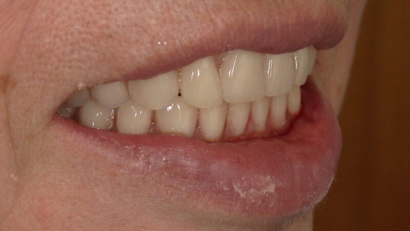 総入れ歯の仮歯は痛い？食べられない時期と慣れるまでの記録②
